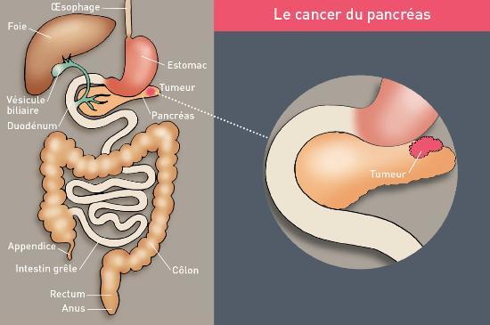 Cancer du pancréas : je m'informe - PÔLE DE CANCÉROLOGIE ...